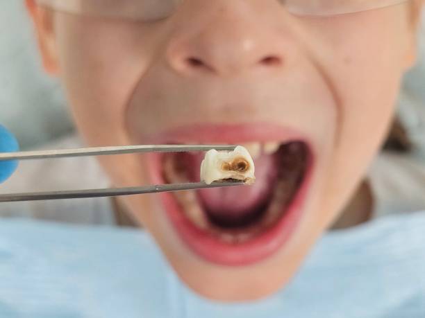 Best Emergency Dental Extractions in Lamont, MI
